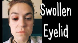 swollen eyelid from eye liner not a