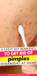 how to get rid of acne overnight 6