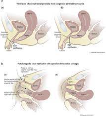 Post-operative complications following feminizing genitoplasty in moderate  to severe genital atypia: Results from a multicenter,