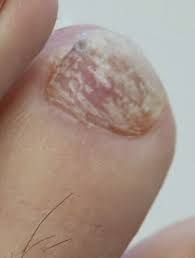 white patches on toenails causes