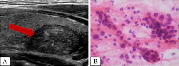 To date, biopsy has remained the gold standard for diagnosing these lesions. Diagnostic Pitfall Of Thyroid Fine Needle Aspiration Induced Fibrosis Follicular Adenoma Mimicking Medullary Thyroid Carcinoma In Frozen Section Diagnostic Pathology Full Text