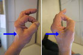 This sensation gives way to a burning feeling within the wrist and hand. Ulnar Nerve Entrapment At The Elbow Cubital Tunnel Syndrome Orthoinfo Aaos