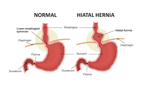 Endometriosis synonyms, endometriosis pronunciation, endometriosis translation, english dictionary definition of endometriosis. Hernia Symptoms Causes Treatment Surgery Narayana Health