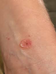 itchy vesicular rash mdedge dermatology