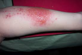 Read more for remedies & treatment. Foot Rash Causes Symptoms And Treatments