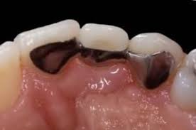 dental bridges cost types procedure