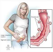 Most colon polyps are harmless. Diverticulosis Diverticulitis Symptoms Treatments Prevention