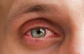 what causes eye allergies and how are
