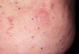 Pictures Different Types Of Acne How To Treat Them