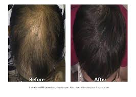 accell prp injections for hair loss treatments in southlake