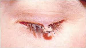 squamous cell papillomas of eyelid