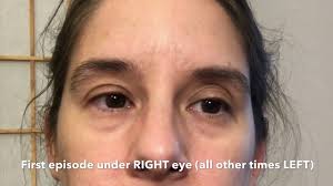 Your eyelid might twitch because of an unusual signal in your brain or the muscles of your face. Under Eye Twitching Now Asynchronously Bilateral Youtube