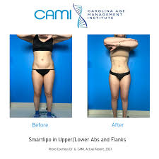 laser lipo smart lipo before after