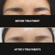 laser tattoo removal for eyebrows
