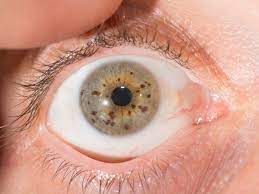 stains in the iris of the eye are