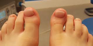 prosthetic toe nails wilde pedique