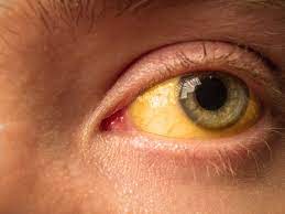 what causes yellow eyes access eye