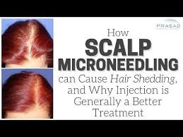 Your jawline and cheekbones as. How Scalp Microneedling Can Cause Temporary Hair Shedding And Advantages Of Injection Treatment Tressless