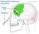 transorbital lobotomy