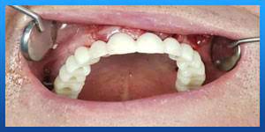 teeth hurt after rhinoplasty teeth