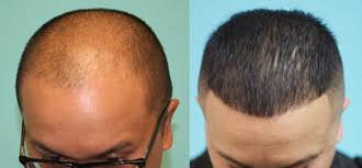 hair loss and hair thinning treatments
