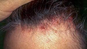 folliculitis scalp symptoms pictures