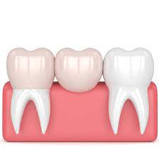 Za izradu keramičkog mosta prvi korak je posjet kod stomatologa. Zubni Most Stomatoloska Ordinacija Smiledesign Kovac