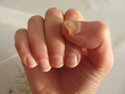 yellow nails what causes yellow nails