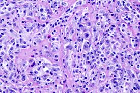 Mediastinal Thymic Large B Cell Lymphoma Images