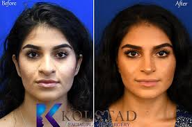 wide tip rhinoplasty results dr