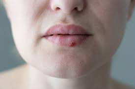 lippenherpes ansteckung risiko