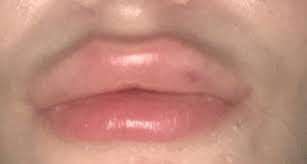 intense pain normal after lip fillers