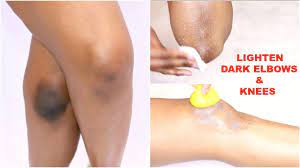 lighten dark elbows knees naturally