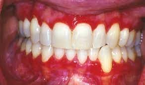 white patches on your gums