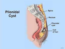 for pilonidal cyst sinus treatment
