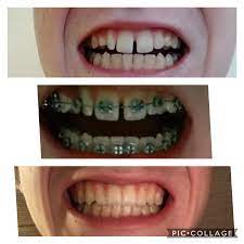 Check out our video about the types of removable retainers and how. Braces Are Definitely Worth It Braces