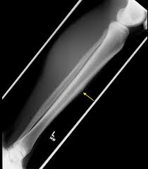 stress fracture of tibia radiology at
