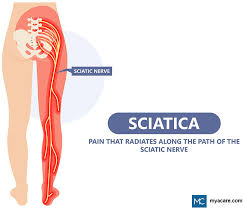 sciatica and leg weakness a worrying