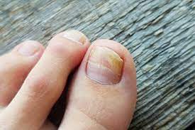 diffe types of toenail fungus