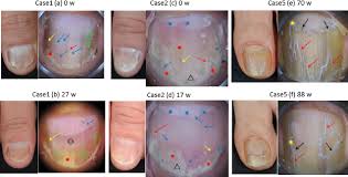 nail psoriasis treated with biologics