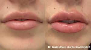 lip augmentation plastic surgeon in
