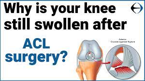 knee still swollen after acl surgery