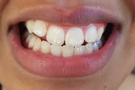 Plaque accumulates and leaves deposits that look white, rough, and chipped. Repair White Spots White Marks On Teeth With Remineralising Toothpaste