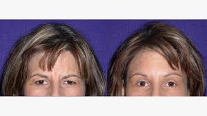 upper blepharoplasty procedure