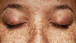veiny eyelids causes treatment and