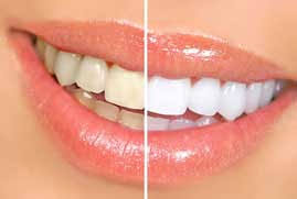 Jun 26, 2020 · 1. Teeth Whitening Teeth Whitening Cost Teeth Scaling And Polishing