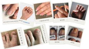 is nail fungus conious preventing