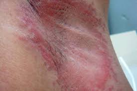armpit rash itchy candida causes