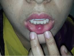 photograph of cystic swelling lower lip