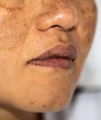 what is hyperpigmentation of the lips